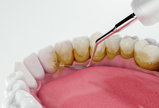Teeth Cleaning